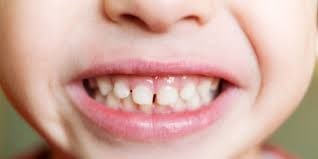 تفاوت های رشد دندانی در کودکان مبتلا به اوتیسم