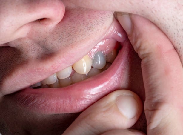 عواملی که روی طول عمر دندان از دست رفته تأثیر می گذارند
