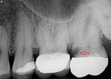 علائم و نشانه های پوسیدگی زیر روکش دندان