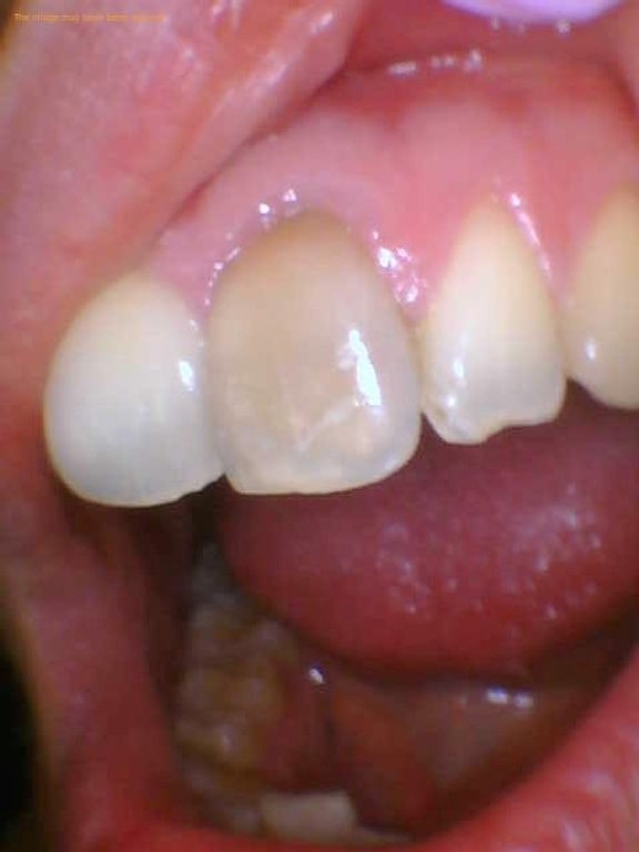نشانه هایی که زمان درمان دندان از دست رفته فرا رسیده است