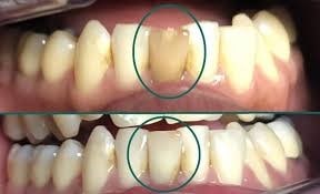 گزینه های درمانی برای دندان از دست رفته