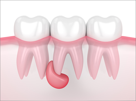 کیست دندان چیست؟
