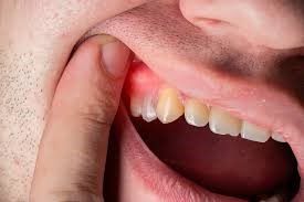انواع فلاکس دندان