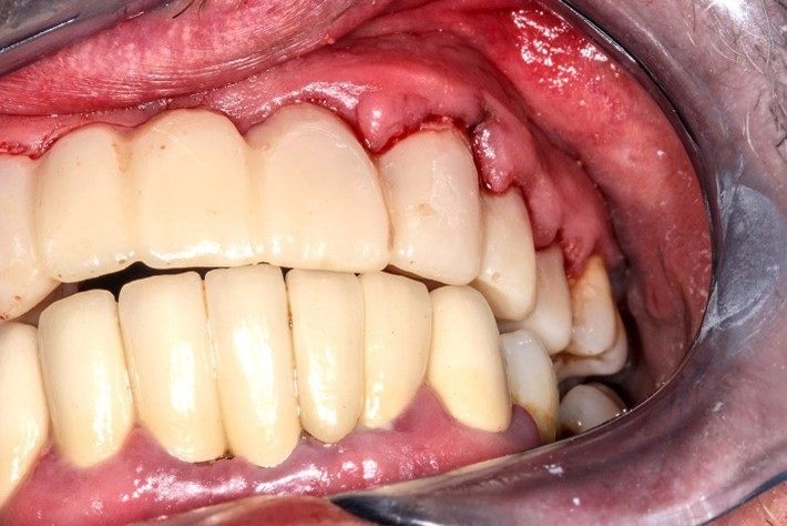 بیماری لثه چگونه می تواند گسترش یابد؟