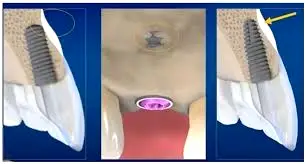 ایمپلنت های دندانی زاویه دار: انتخاب کلاسیک