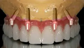 کاربردهای رایج برای تکنیک های ایمپلنت زاویه دار عبارتند از: